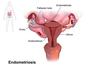 Endometriosis. By BruceBlaus.Medical gallery of Blausen Medical 2014. WikiJournal of Medicine