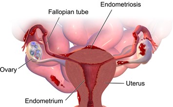 Endometriosis. By BruceBlaus.Medical gallery of Blausen Medical 2014. WikiJournal of Medicine