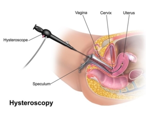 Hysteroscopy. By BruceBlaus